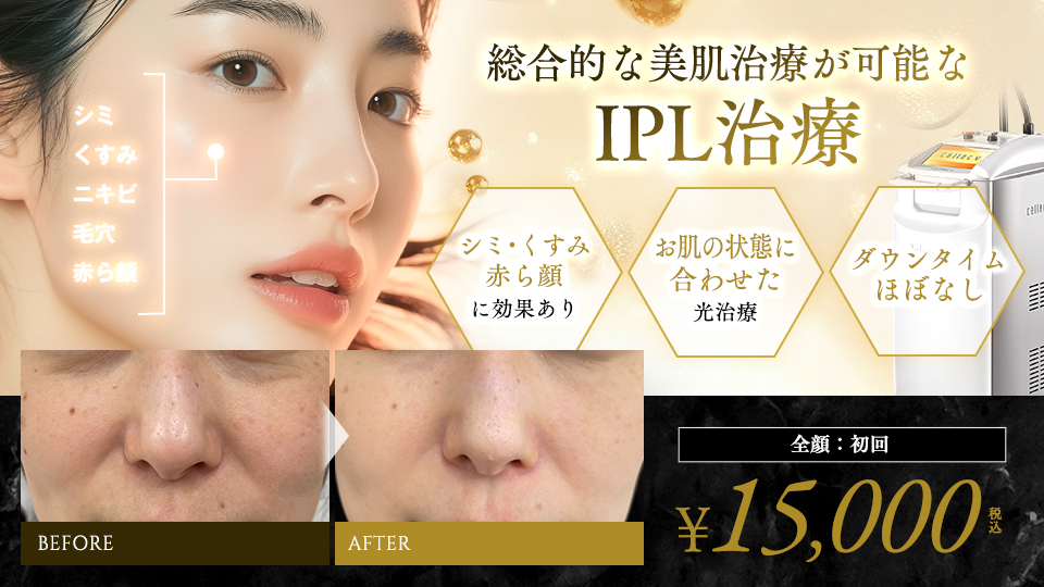 IPL光治療（セレックV）