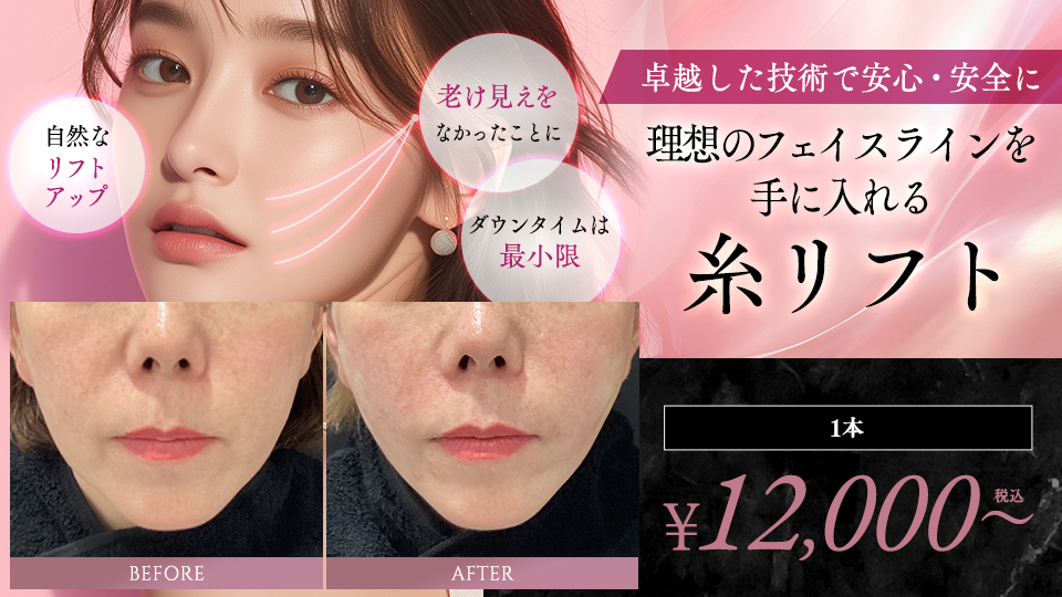 糸リフト（スレッドリフト）